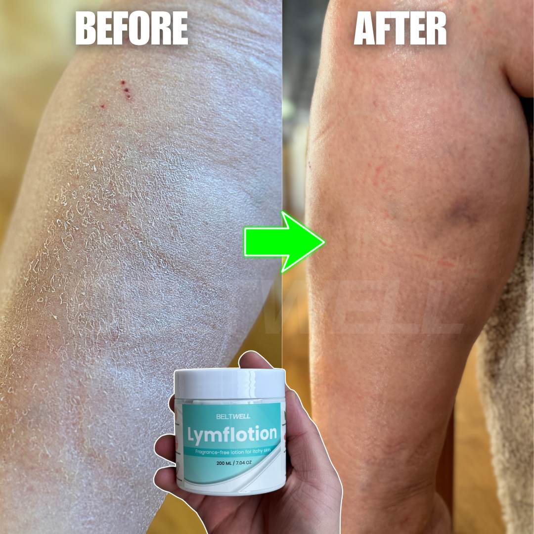 Lymfolotion - Fragrance-Free Non-Greasy Anti-Itch Lotion